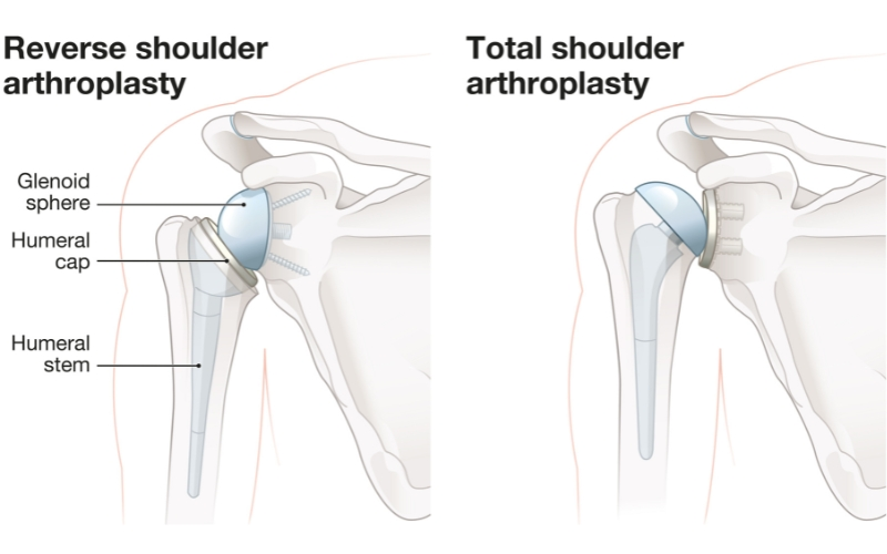 How Much Does Private Shoulder Replacement Surgery Cost?